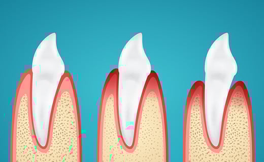 dca-blog_causes-of-gingivitis-and-gum-disease