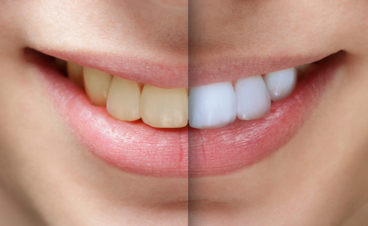 dca-blog_teeth-whitening-tooth-comparison