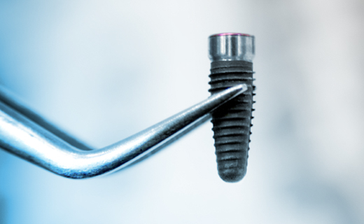 dca-blog_what-can-i-expect-from-the-implant-supported-denture-process